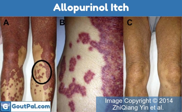 Allopurinol Itch