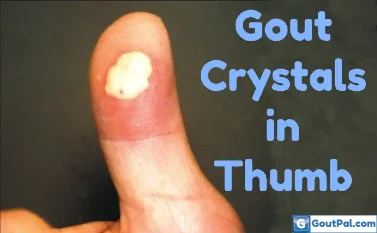 Gout Crystals In The Thumb