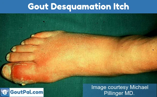 Gout Desquamation Itch