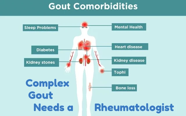 Complex Gout needs a Rheumatologist
