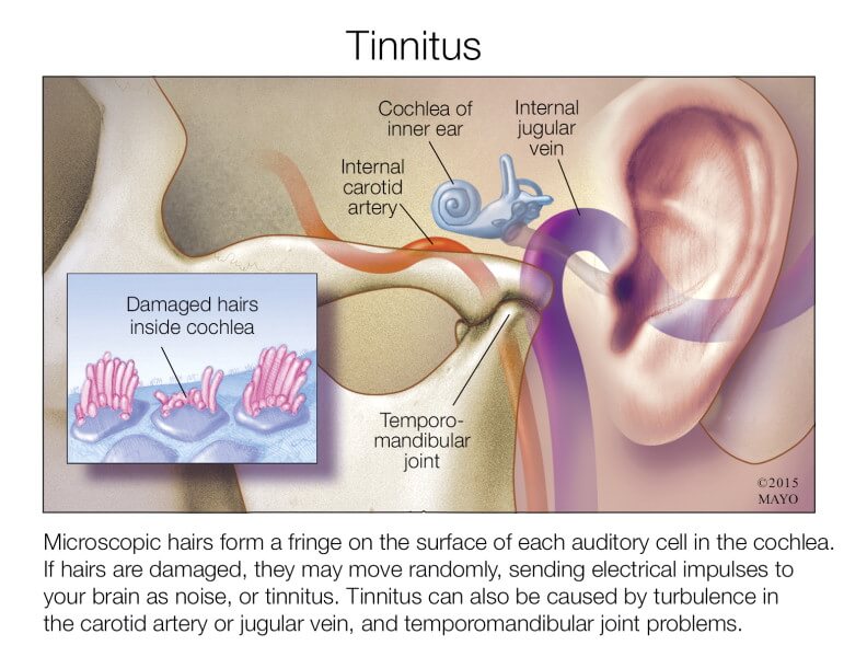 Can Gout Cause Tinnitus media