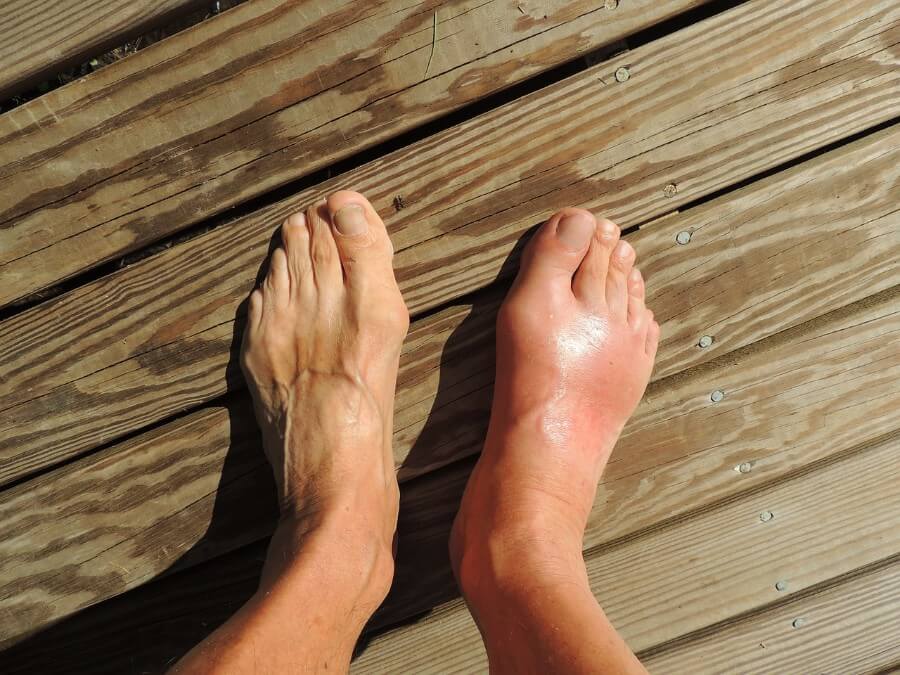 Gout Swollen Foot photo