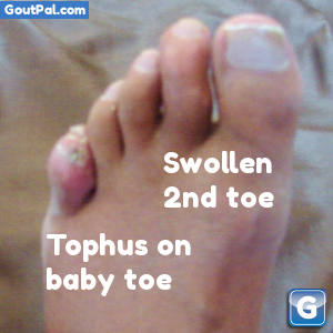 Can you get gout in your baby toe?