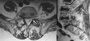 Gout in Spine MRI