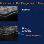 Ultrasound of early chronic gout duration timeline