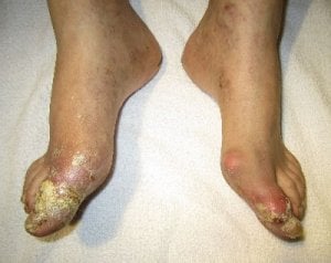 Gout Symptoms,  Causes, & Diagnosis