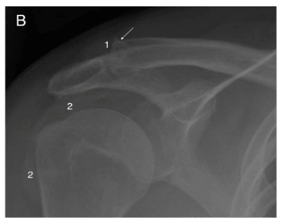 Gout in Shoulder X-ray image