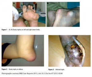 Painless Gout Photographs