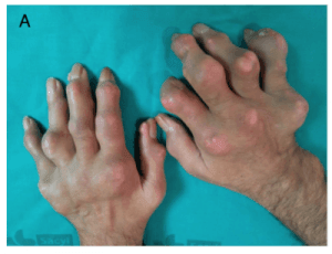 Tophaceous Gout in Hands photo