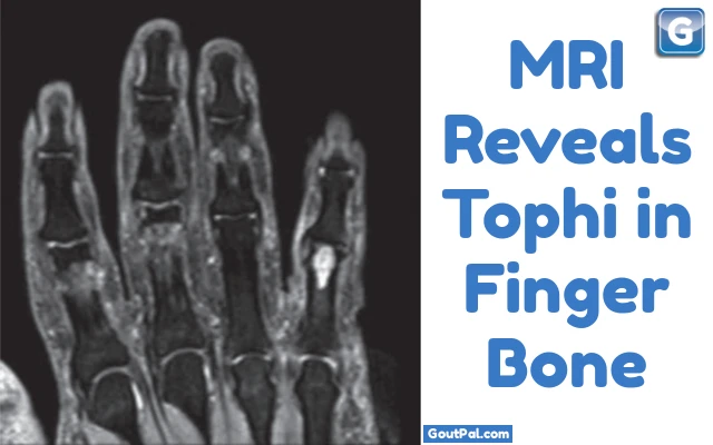 MRI Shows Gouty Tophi in Finger Bone