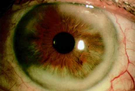 Gouty Eye